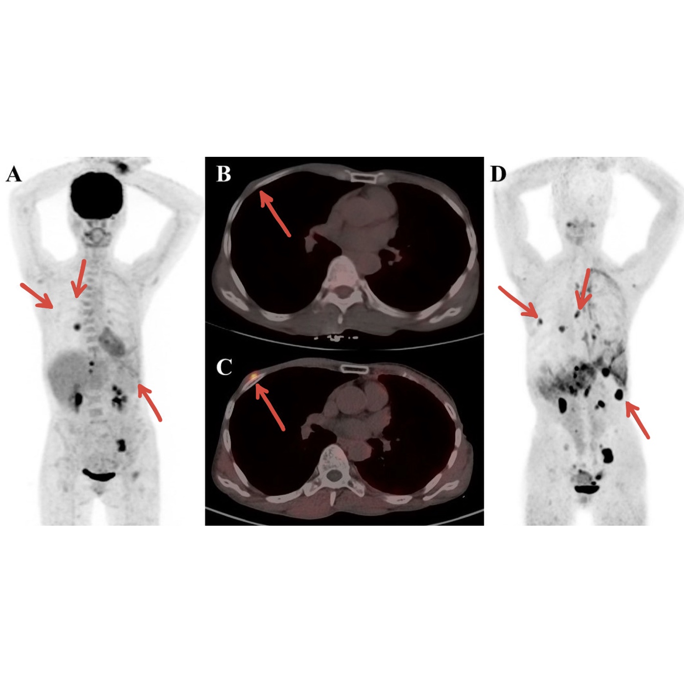 Mit Hilfe der sogenannten PET-CT- Untersuchungen können Metastasen sichtbar gemacht werden. 